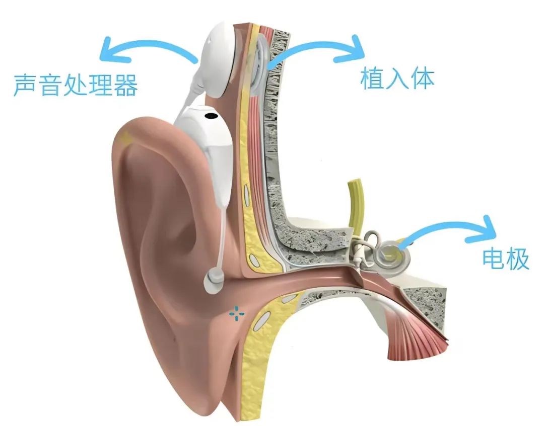 人工耳蝸技術革新突破聽覺障礙壁壘，開啟嶄新篇章